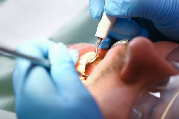 Best Emergency Dentist for Knocked-Out Tooth in La Mesa, CA
